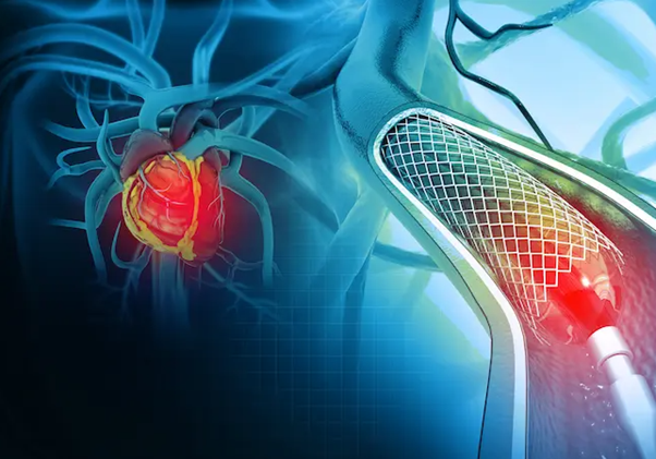 Why Heart Stent Valve Drawings Are Required for Patent Protection